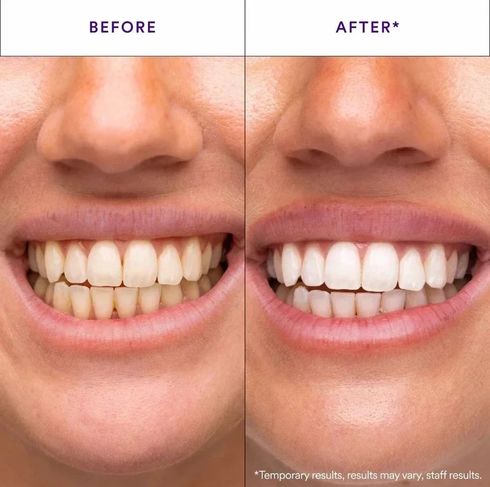 Hismile V34 Whitening Strips, Teeth WhiteningStrips, Purple Tooth Whitening
