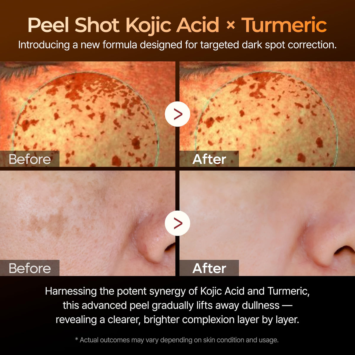 Dr.Melaxin Peel Shot Kojic Acid Turmeric Serum — 80ml exfoliating AHA/BHA pore-refining brightening ampoule