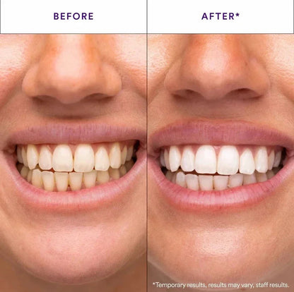 Hismile V34 Whitening Strips, Teeth WhiteningStrips, Purple Tooth Whitening